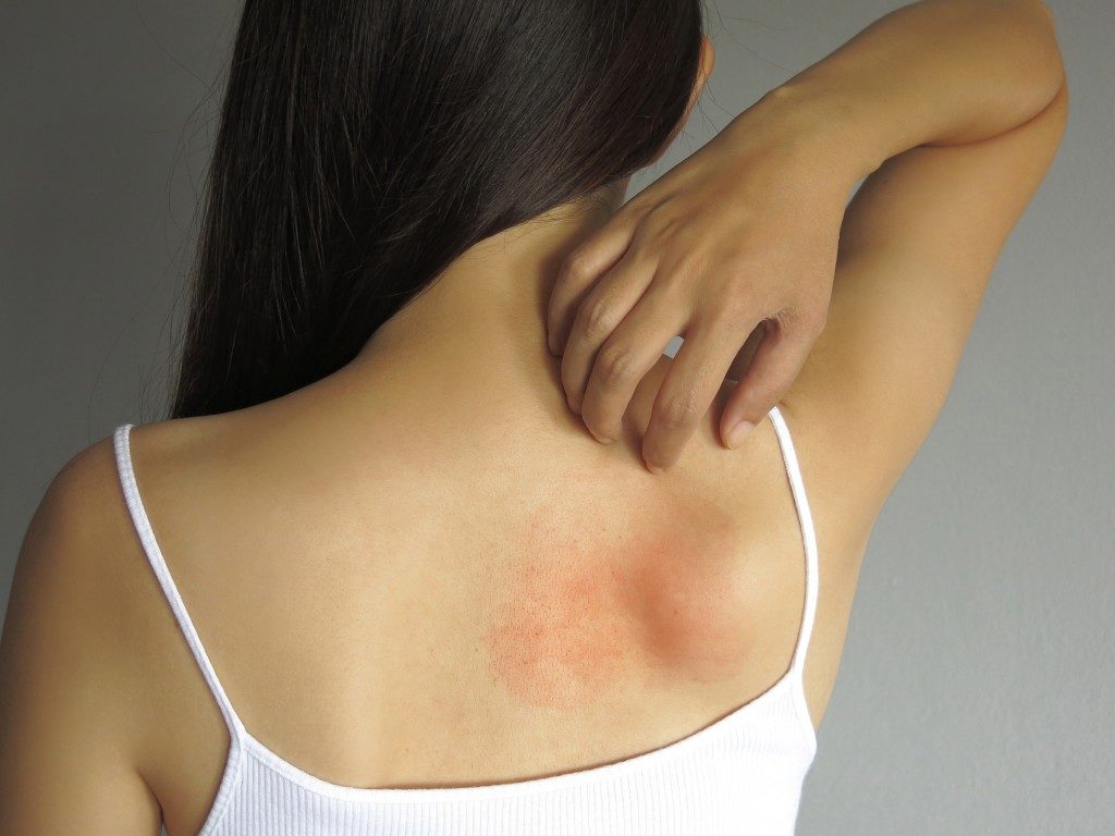 Woman with allergies on her back